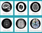 Oprogramowanie medycznej sztucznej inteligencji Darmiyan BrainSee może wcześnie wykrywać oznaki choroby Alzheimera. (Źródło: Darmiyan)
