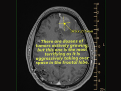 Skan z rezonansu magnetycznego Michaela Prinke'a przesłany przez jego żonę w mediach społecznościowych