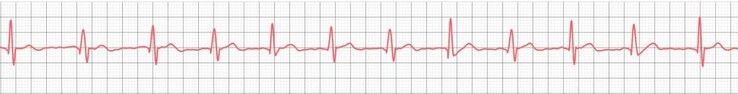 Nawet niedrogie smartwatche udowodniły, że potrafią z powodzeniem rejestrować podstawowe zapisy EKG