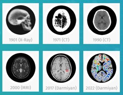 Oprogramowanie medycznej sztucznej inteligencji Darmiyan BrainSee może wcześnie wykrywać oznaki choroby Alzheimera. (Źródło: Darmiyan)