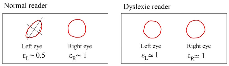 Centroidy Maxwella różnią się symetrią u osób zdrowych, ale są podobne u osób z dysleksją. (Źródło zdjęcia: DOI 10.3390/brainsci13101478)